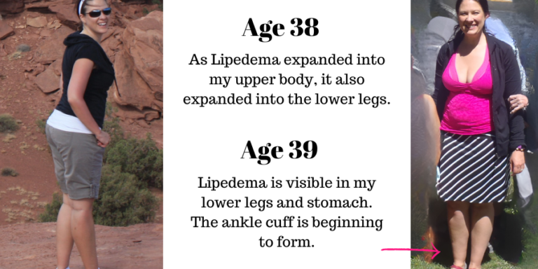 My Lipedema Story – Part 4 – Rapid Progression – The Healing Blossom